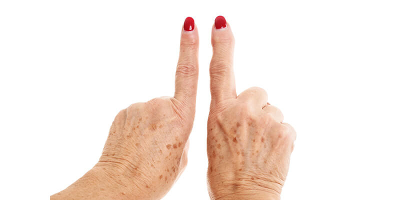 Artrosis de manos – Fisioterapia a tu alcance