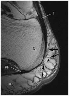 Comparación de la efectividad del tratamiento con  movilización y técnicas de energia muscular de la articulación calcaneocuboidea, frente al tratamiento con ondas de choque extracorporeas, en la fascitis plantar