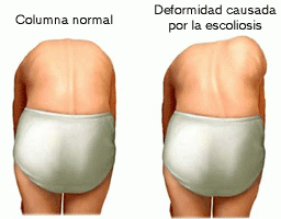 TRATAMIENTO CONSERVADOR PARA LA ESCOLIOSIS: EL MÉTODO SCHROTH