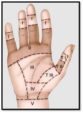 Lesiones de tendones flexores de mano