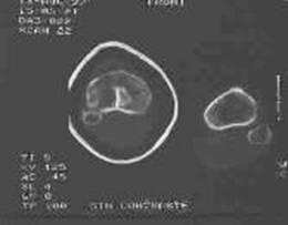 Fracturas de meseta tibial