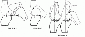 Aplicación de hidroterapia en plastia de ligamento cruzado anteroexterno