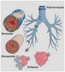 Propuesta de abordaje fisioterapico para enfermedades respiratorias obstructivas.