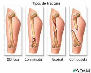 Generalidades de las fracturas