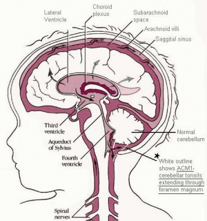 La malformación de Arnold Chiari