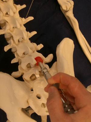 Ajustes lumbares con Percutor Estructural Efectos en la pisada