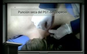 Fisioterapia invasiva: Puntos gatillo y punción seca en el dolor musculoesquelético