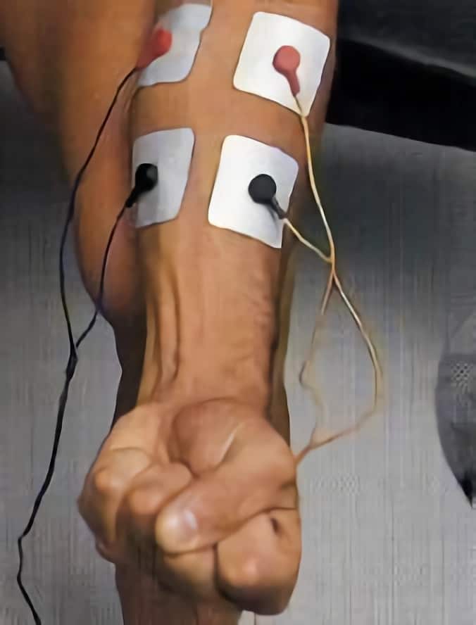 https://www.efisioterapia.net/tienda/img/cms/colocacion-electrodos-flexores-mano.jpg
