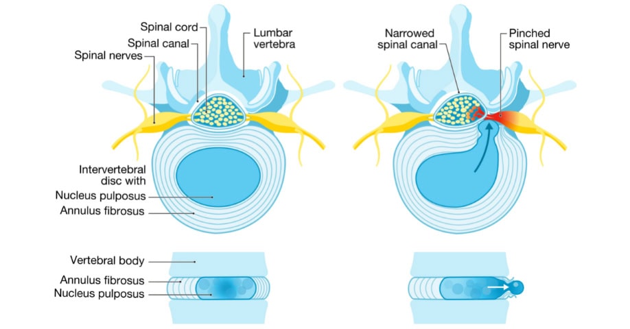 Ilustración con disco normal (izquierda) y hernia discal (derecha)