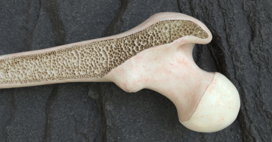 Renderizado mostrando huesos del muslo con osteoporosis