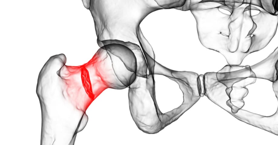 Síntomas de la osteonecrosis: Ilustración muestra fractura del fémur 